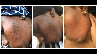 7 DAYS TURMERIC FACE MASK CLEARED MY ACNES AND HYPERPIGMENTATION BEFORE AND AFTER IN THE VIDEO [upl. by Ninon]