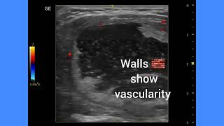 Large colloid cyst of thyroid with lobulation and mobile colloid particles ultrasound video [upl. by Hanahsuar]