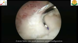 Surgical Technique to Repair Musculotendinous Junction Tear of Supraspinatus Using LateralRow [upl. by Doughman186]