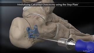 Medializing Calcaneal Osteotomy using the Step Plate™ [upl. by Ricardama233]