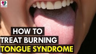 How to Treat Burning Tongue Syndrome  Health Sutra [upl. by Retlaw]