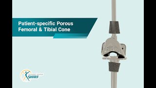 Patientspecific Porous Femoral amp Tibial Cone [upl. by Nyrroc]