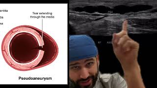 Pseudoaneurysm case review [upl. by Airrotal]