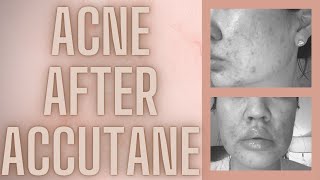 MY ACNE CAME BACK AFTER ACCUTANE  WHAT CAUSED IT WHAT I TRIED amp WHAT WORKED [upl. by Ineslta]