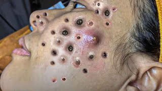 Big Cystic Acne Blackheads Extraction Blackheads amp Milia Whiteheads Removal Pimple Popping  424 [upl. by Oberheim]