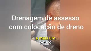 Drenagem de abscesso extra oral sem dor sob hipnoseDraining of abscess without pain under hypnosis [upl. by Eloisa]