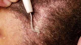 Dandruff Scratching Flaky Edges Removal With Dental Pick [upl. by Itsym]