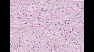 Histopathology SkinGranular cell tumor [upl. by Nicodemus624]