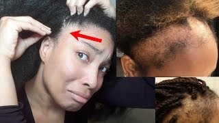 How To Regrow Your Hair and Prevent Hair Loss  15 Tips Against Traction Alopecia The First Steps [upl. by Eelasor]