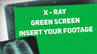 XRay Medical Green Screen  Graphics amp Animation [upl. by Eliga176]