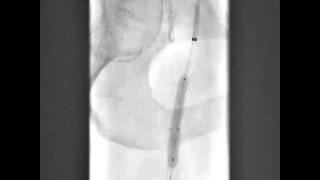 InStent Restenosis Treated with Angioslide [upl. by Ettecul]