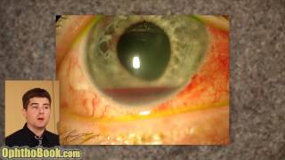 Exploding Eye Lecture [upl. by Trelu]