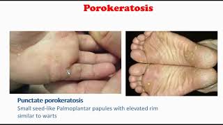 Porokeratosis [upl. by Pacian428]