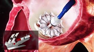 Cardiovalve Mitral Valve replacement Animation [upl. by Leoj]