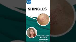 Treatment of shingles in homeopathy [upl. by Eico]