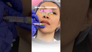 Lip Filler Treatment lipfiller fillerbibir trending trendingshorts [upl. by Cummings928]