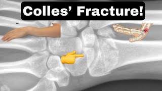 Colles’ Fracture facts shorts collesfracture [upl. by Nelo]