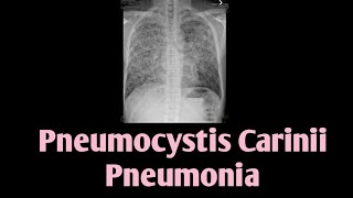 Pneumocystis Carinii Pneumonia  PCP  Pneumocystis Jirovecii [upl. by Kneeland]