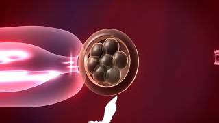 Preimplantation Genetic Diagnosis PGD [upl. by Bodrogi]