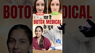 You will be shocked to know the uses of Botox for Medical Uses 😱 shorts botoxtreatment [upl. by Yditsahc421]