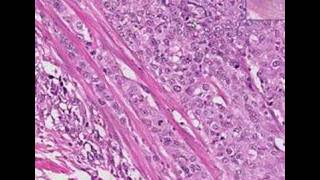 Histopathology Urinary bladderTransitional cell carcinoma [upl. by Correna]