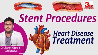 Stent Procedure for Heart Blocks I Heart Disease Treatment I Dr Saket [upl. by Ynehpets279]