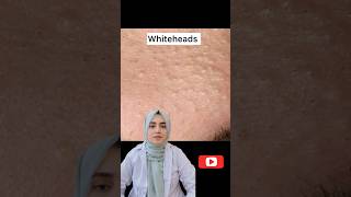 Get Acne free Skin 5 medicines for pimples blackheads and whiteheads trending viralvideo [upl. by Obediah]