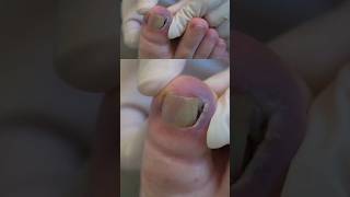 Bleeding of an ingrown nail can be made worse by doing this [upl. by Ysirhc]