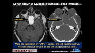 Sphenoid Sinus Mucous Retention Cyst vs Mucocele [upl. by Henryetta]