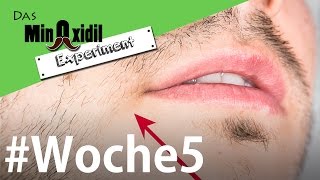 Fortschritte und Nebenwirkungen  Das Minoxidil Experiment Woche5 [upl. by Hubert]