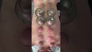 FIRE CUPPING THERAPY ASMR [upl. by Ggerk297]