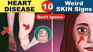 10 Skin Signs of Heart Disease  Coronary Artery Disease  Heart Attack [upl. by Goulder747]