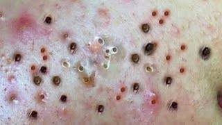 Soothing Blackhead Extraction ASMR Compilation PART 4 [upl. by Eniamraj597]