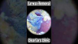 How to get wax out of your ear ear wax removal  ear cleaning  ASMR  relaxation  relax [upl. by Angelia]