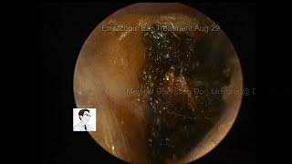 Cerumen Ear wax removal processing in little friend and adult [upl. by Accalia310]