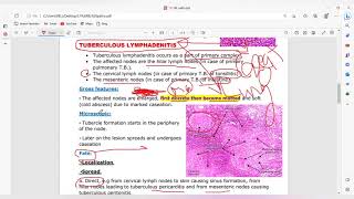 Non neoplastic lymhoma [upl. by Noira]