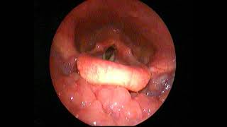 Videolaryngoscopy  Laryngopharyngeal reflux [upl. by Vigen]