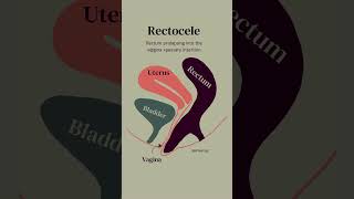 Prolapse Rectocele Symptoms and Treatment [upl. by Jori27]