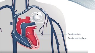 Traitement par stimulateur cardiaque [upl. by Keare]