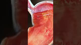 Stomach Acid Relux stomach acidity shorts [upl. by Erodavlas363]