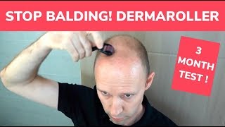 STOP BALDING  Dermaroller 3 Month Test and Tutorial [upl. by Vandervelde433]