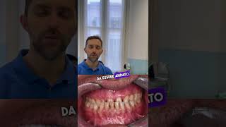 Faccette Dentali  Studio Dentistico Ciatti Legnano dentista faccettedentali estetica [upl. by Llewsor]