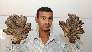 Surgeries Give “Tree Man” His Life Back [upl. by Aneekan]