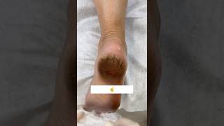 👠Get Rid Of Cracked Heels  Repair Cracked Heels In 1Day cracked heels feetcare youtubeshorts [upl. by Aman]