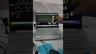 TRANSCUTANEOUS PACING SIMULATION  LAERDAL SIMMAN amp NIHON KOHDEN DEFIB  DR SREENIVASARAO SURISETTY [upl. by Endora82]