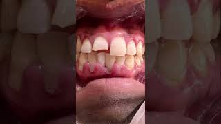 Dental talk 24 Big food bites mastication tmj tartaroralcareoralhealth oralhealthmatters [upl. by Thorr]