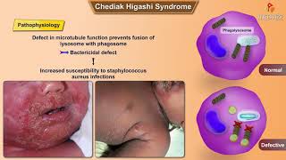 ChediakHigashi syndrome [upl. by Nobe]