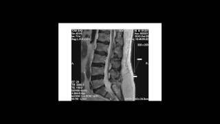 Degenerative disk disease progression over time [upl. by Crotty]