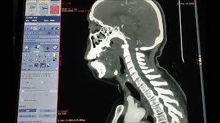 ANATOMIA SECCIONAL  AngioTC Carótidas SAGITAL [upl. by Atnuahs]