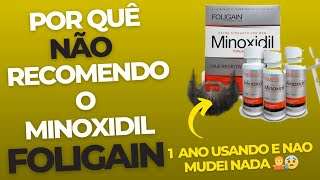 DICA PARA BARBA 1 ano passando minoxidil foligain na barba e nada [upl. by Namhar295]